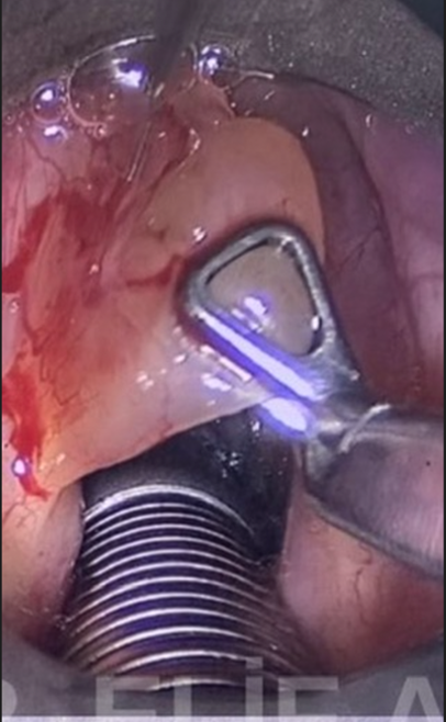 Vocal Cord Microsurgery